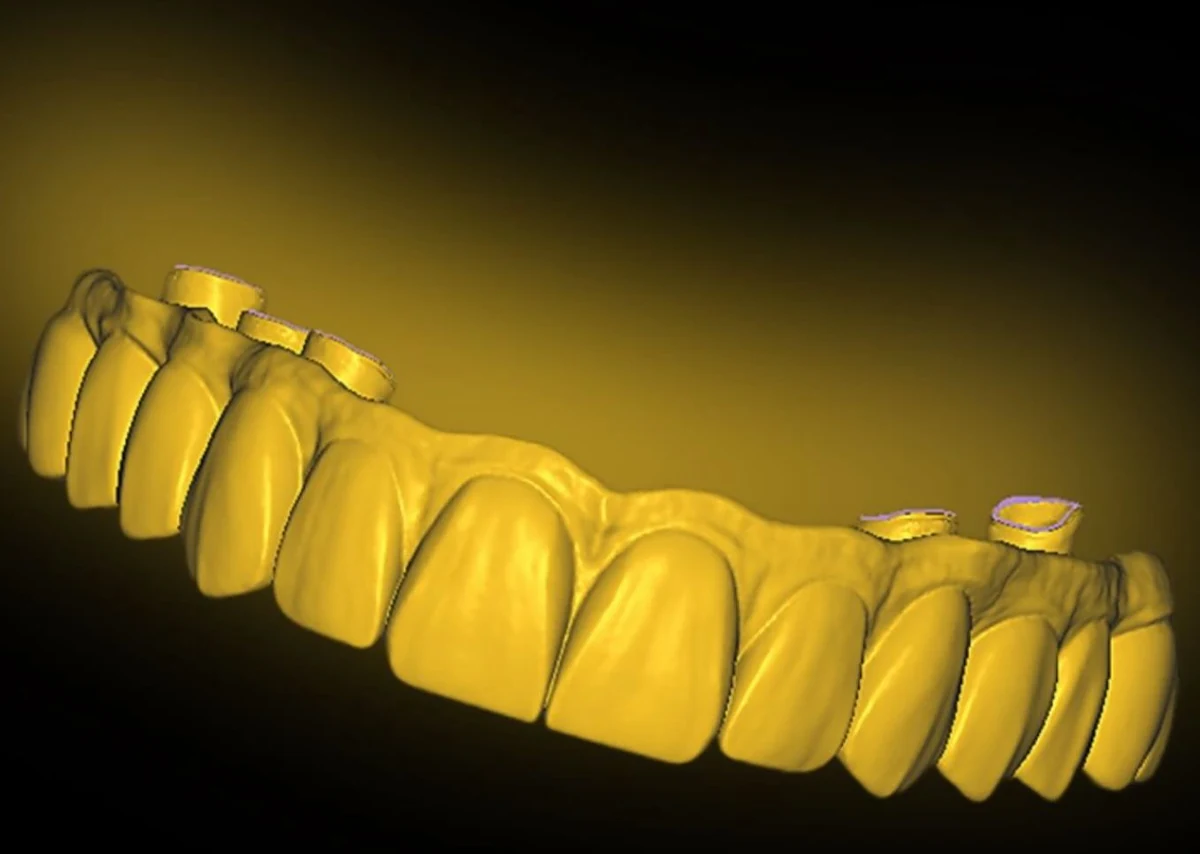 Yellow CAD rendering showing anterior restorative form across an arch