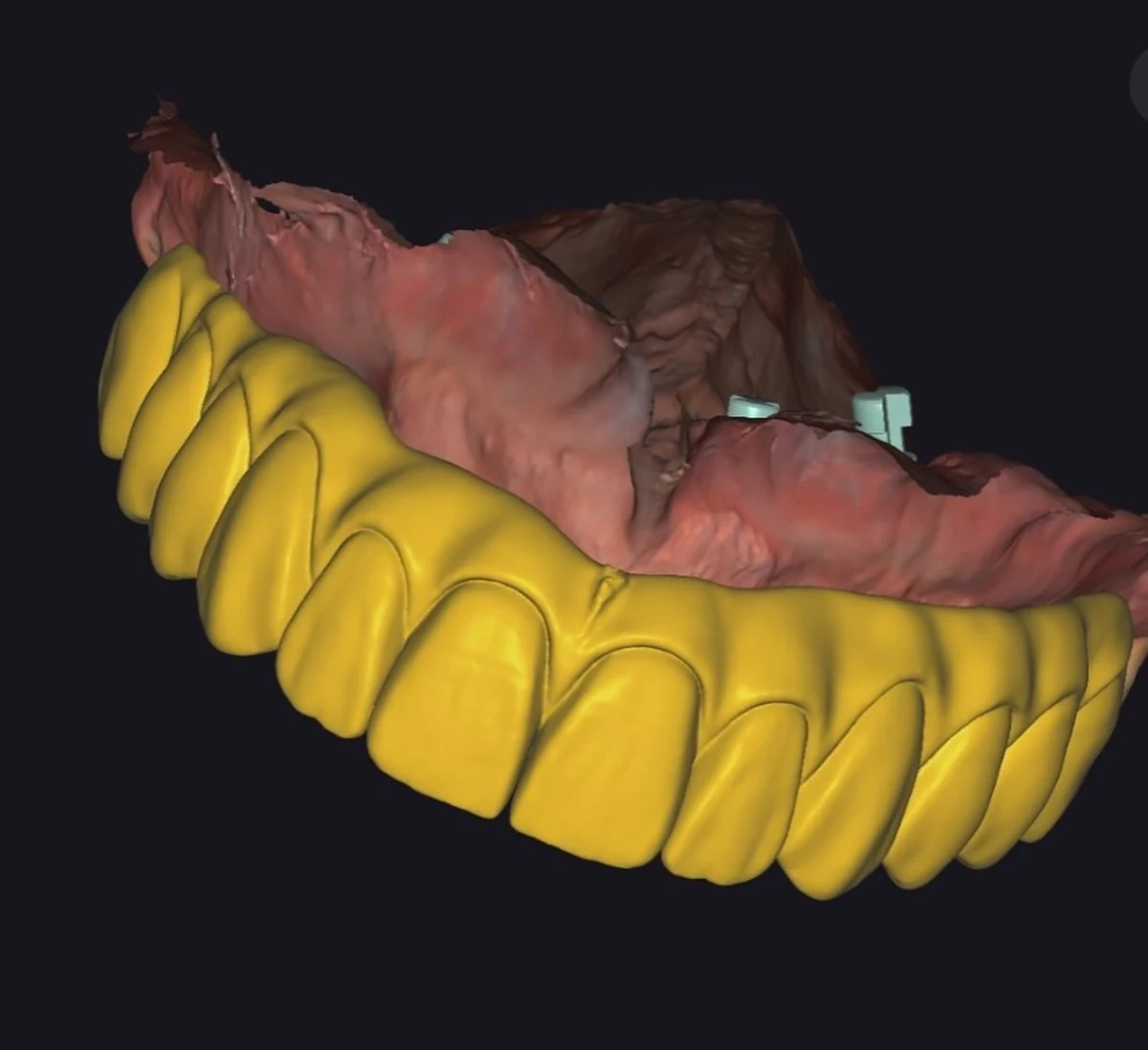 Yellow anterior restorative CAD design shown against a scanned arch