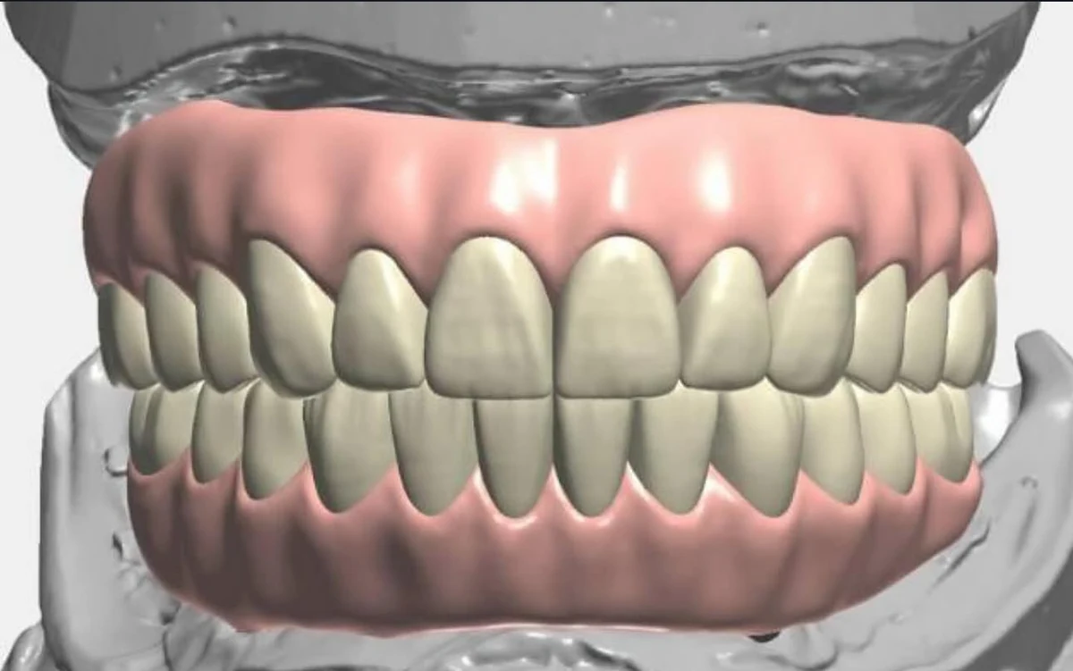 Frontal CAD view of upper and lower digital denture designs