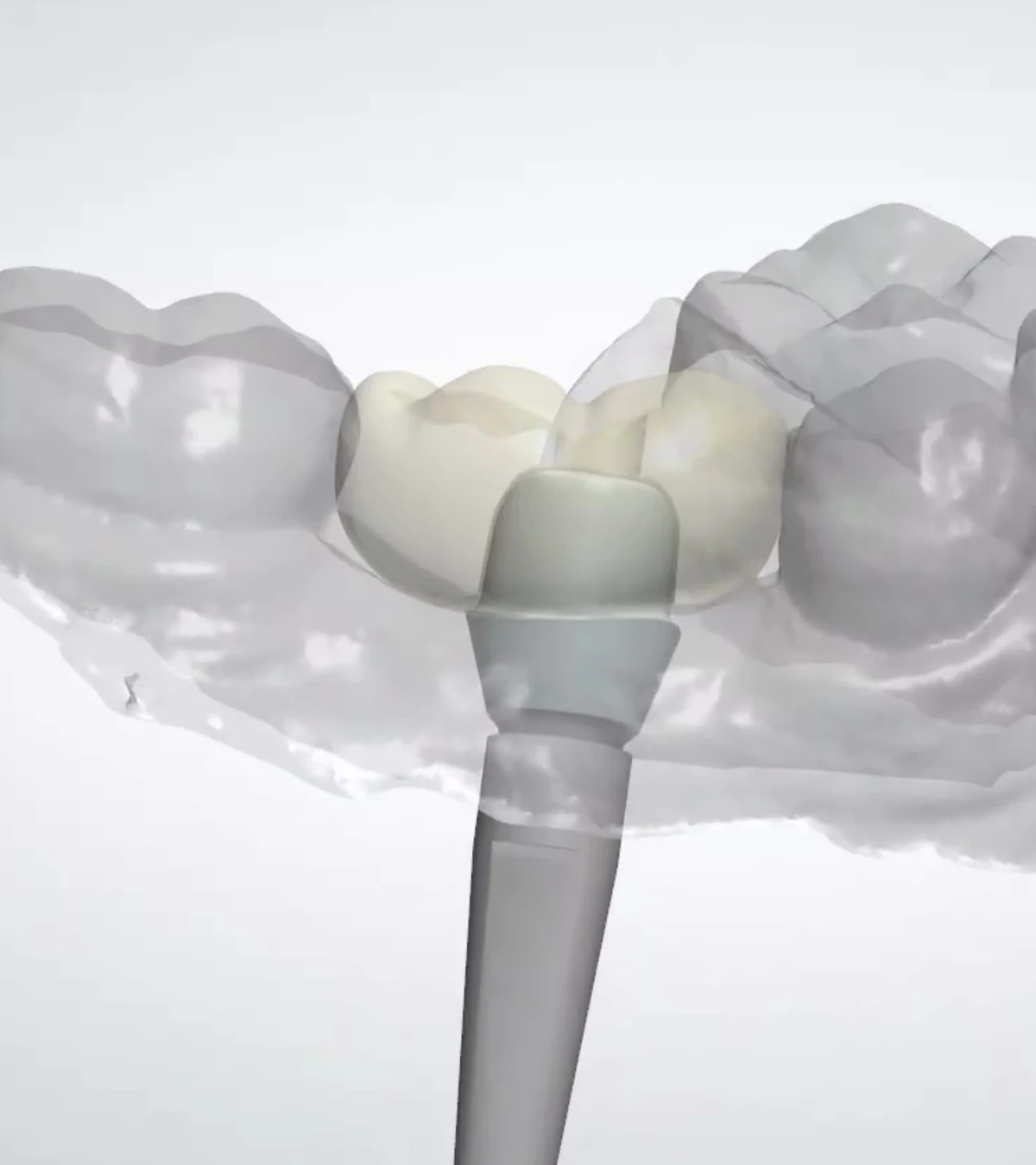 CAD view of an implant restoration and abutment within a scanned arch
