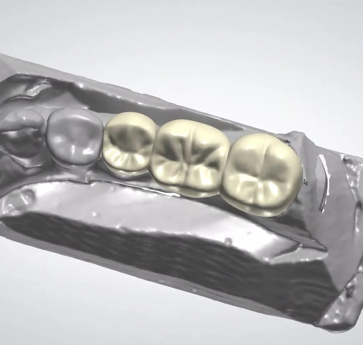 CAD view of three posterior crown designs in a scanned arch